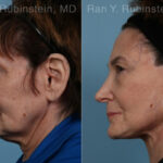 Face lift & Neck lift Before and After Photos in Montvale, NJ, Patient 24509