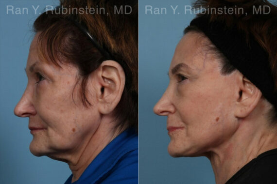 Face lift & Neck lift Before and After Photos in Montvale, NJ, Patient 24509