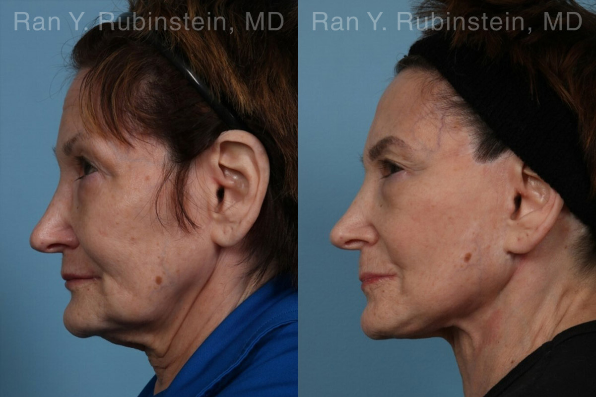 Face lift & Neck lift Before and After Photos in Montvale, NJ, Patient 24509