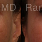 Sculptra Face Before and After Photos in Montvale, NJ, Patient 21141
