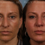 Sculptra Face Before and After Photos in Montvale, NJ, Patient 21141