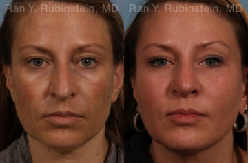 Sculptra Face Before and After Photos in Montvale, NJ, Patient 21141