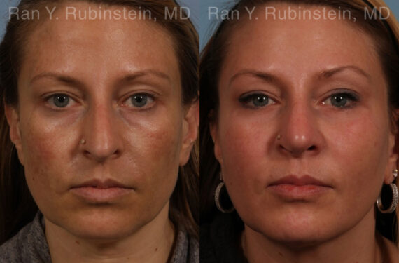 Sculptra Face Before and After Photos in Montvale, NJ, Patient 21141