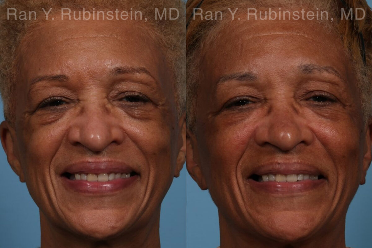 Sculptra Face Before and After Photos in Montvale, NJ, Patient 21755