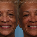 Sculptra Face Before and After Photos in Montvale, NJ, Patient 21755