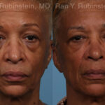 Sculptra Face Before and After Photos in Montvale, NJ, Patient 21755