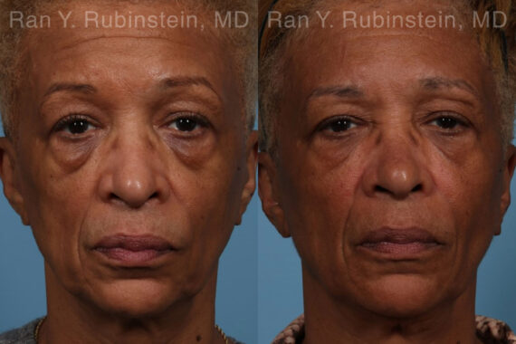 Sculptra Face Before and After Photos in Montvale, NJ, Patient 21755