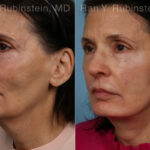 Face lift & Neck lift Before and After Photos in Montvale, NJ, Patient 24816