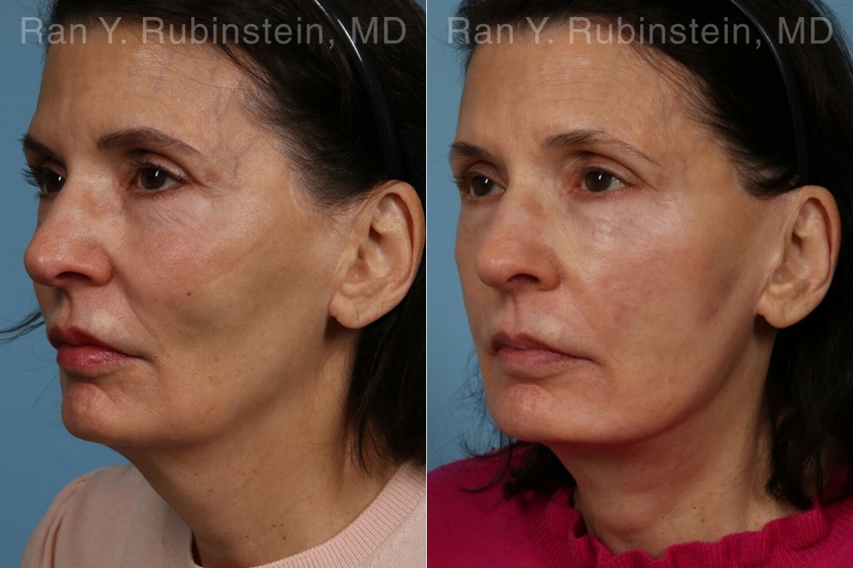 Face lift & Neck lift Before and After Photos in Montvale, NJ, Patient 24816