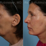 Face lift & Neck lift Before and After Photos in Montvale, NJ, Patient 24816