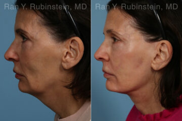 Face lift & Neck lift Before and After Photos in Montvale, NJ, Patient 24816