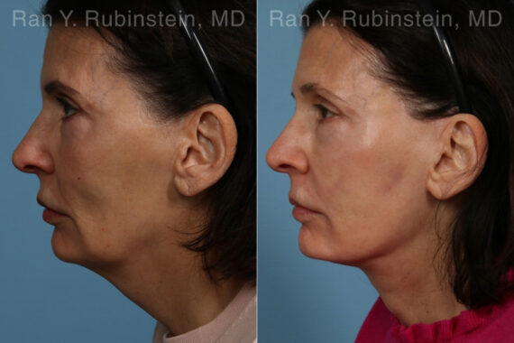 Face lift & Neck lift Before and After Photos in Montvale, NJ, Patient 24816
