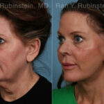Face lift & Neck lift Before and After Photos in Montvale, NJ, Patient 24825