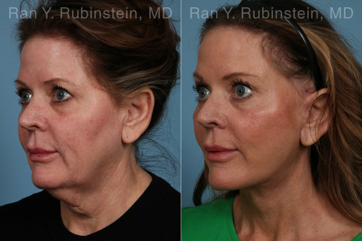 Face lift & Neck lift Before and After Photos in Montvale, NJ, Patient 24825