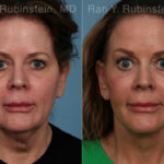 Face lift & Neck lift Before and After Photos in Montvale, NJ, Patient 24825
