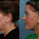 Face lift & Neck lift Before and After Photos in Montvale, NJ, Patient 24825