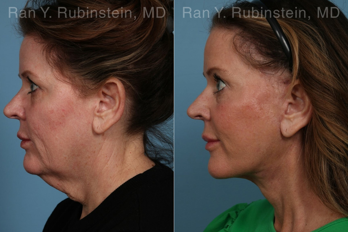 Face lift & Neck lift Before and After Photos in Montvale, NJ, Patient 24825