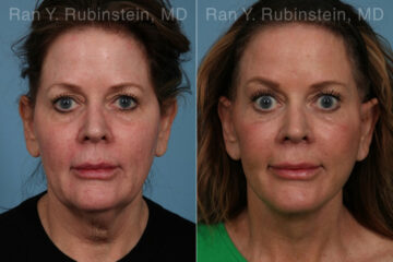 Face lift & Neck lift Before and After Photos in Montvale, NJ, Patient 24825