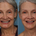 Face lift & Neck lift Before and After Photos in Montvale, NJ, Patient 24907