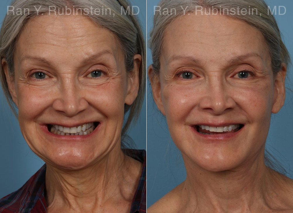 Face lift & Neck lift Before and After Photos in Montvale, NJ, Patient 24907