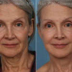 Face lift & Neck lift Before and After Photos in Montvale, NJ, Patient 24907