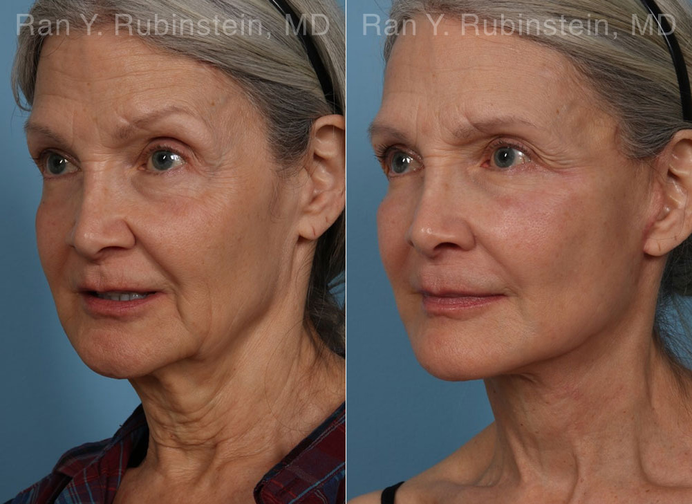 Face lift & Neck lift Before and After Photos in Montvale, NJ, Patient 24907