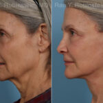 Face lift & Neck lift Before and After Photos in Montvale, NJ, Patient 24907