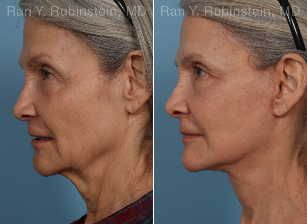 Face lift & Neck lift Before and After Photos in Montvale, NJ, Patient 24907
