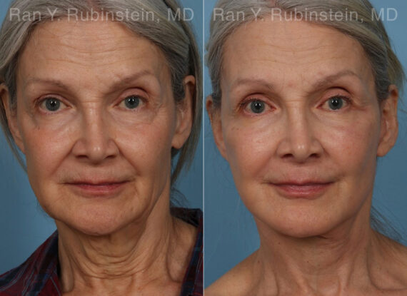 Face lift & Neck lift Before and After Photos in Montvale, NJ, Patient 24907