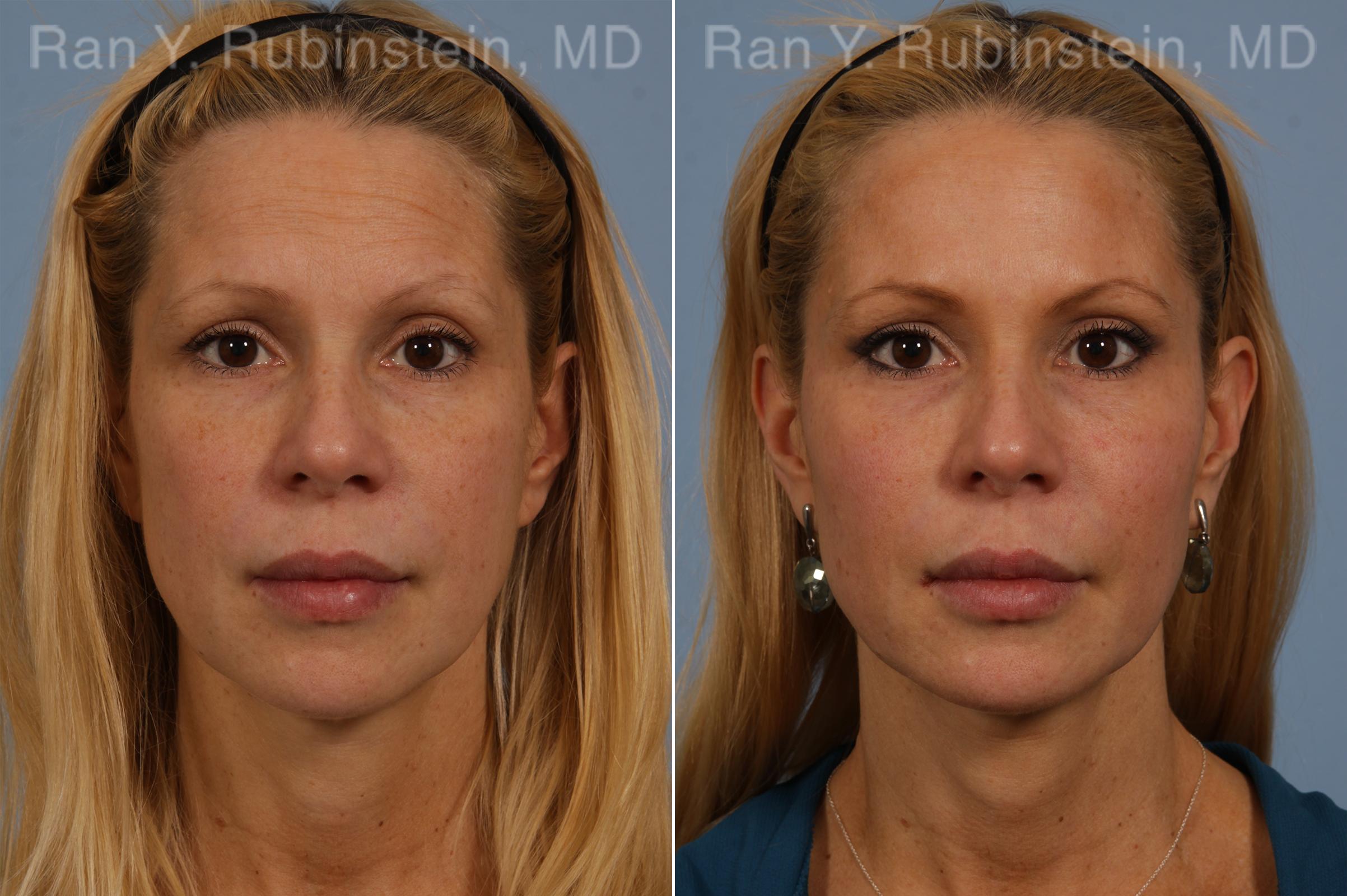 injectable-fillers-before-after