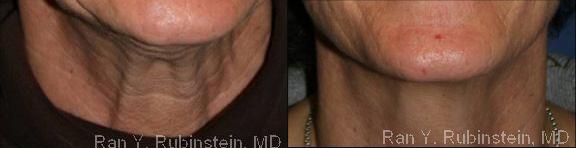 patient-12282-botox-before-after-3