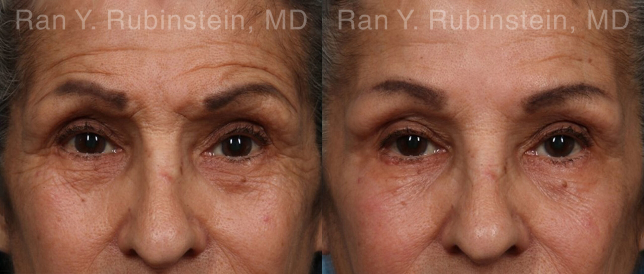 patient-17907-botox-before-after-1