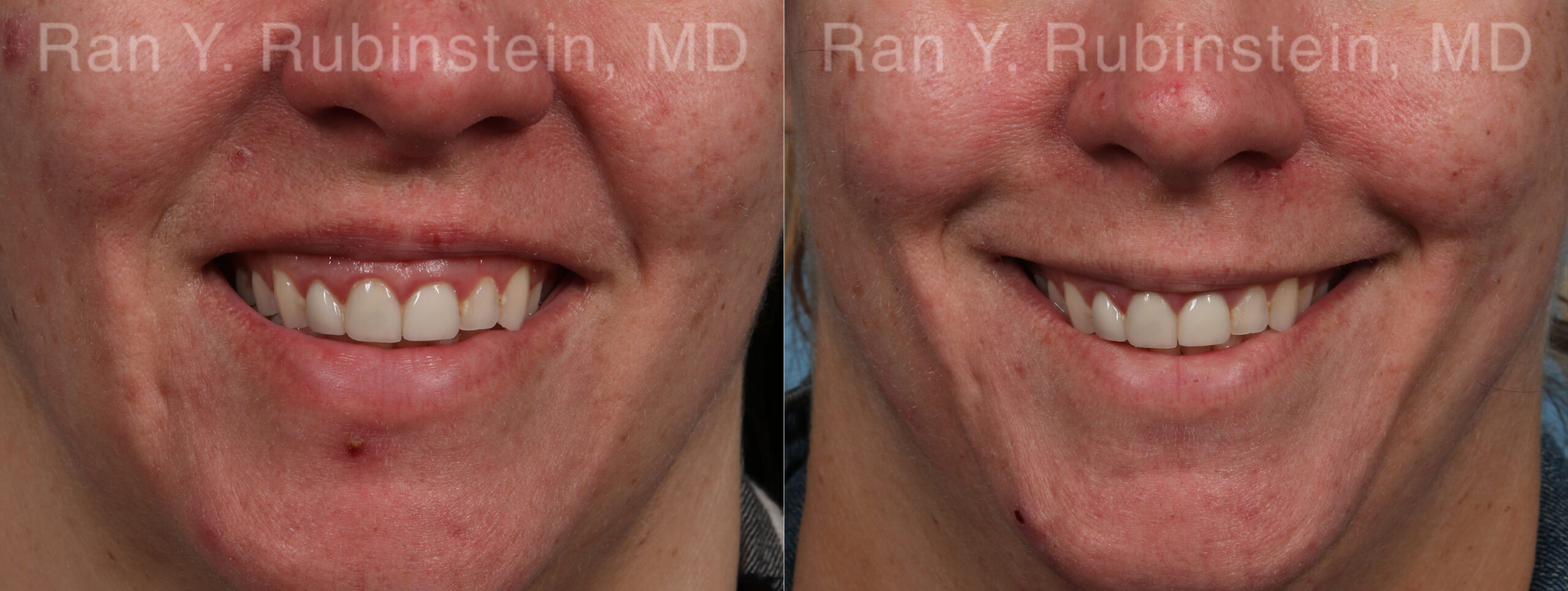 patient-21747-botox-before-after