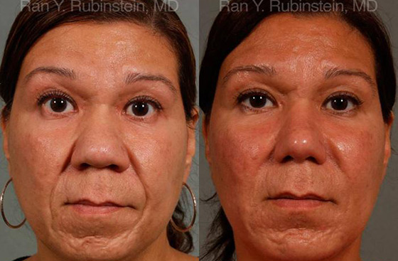 ethnic-rhinoplasty-before-after