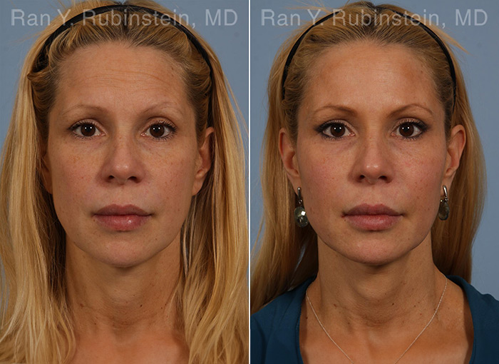 injectable-fillers-before-after