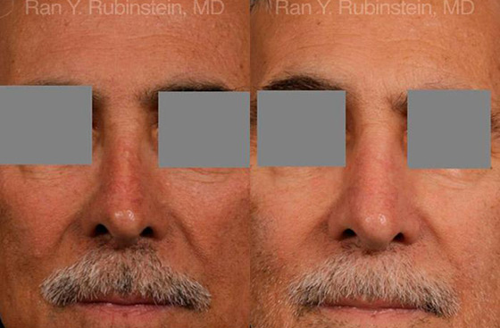 liquid-rhinoplasty-before-after