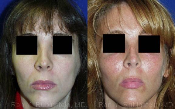Before & After Cheek Augmentation