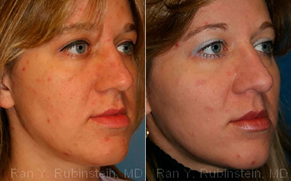patient-12376-cheek-augmentation-before-after