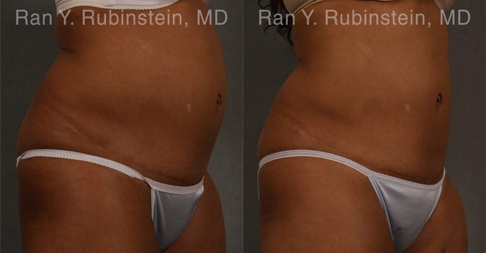 patient-12429-coolsculpting-before-after-6