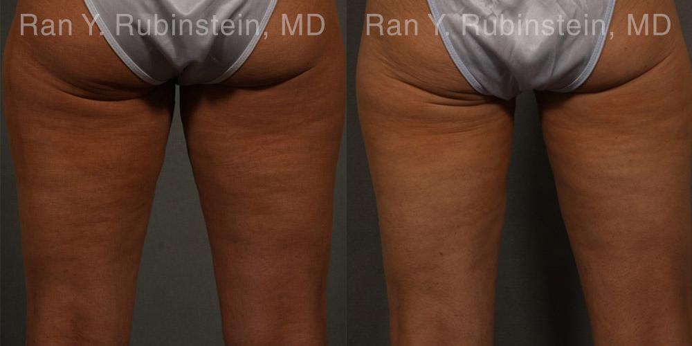 patient-12459-coolsculpting-before-after-6