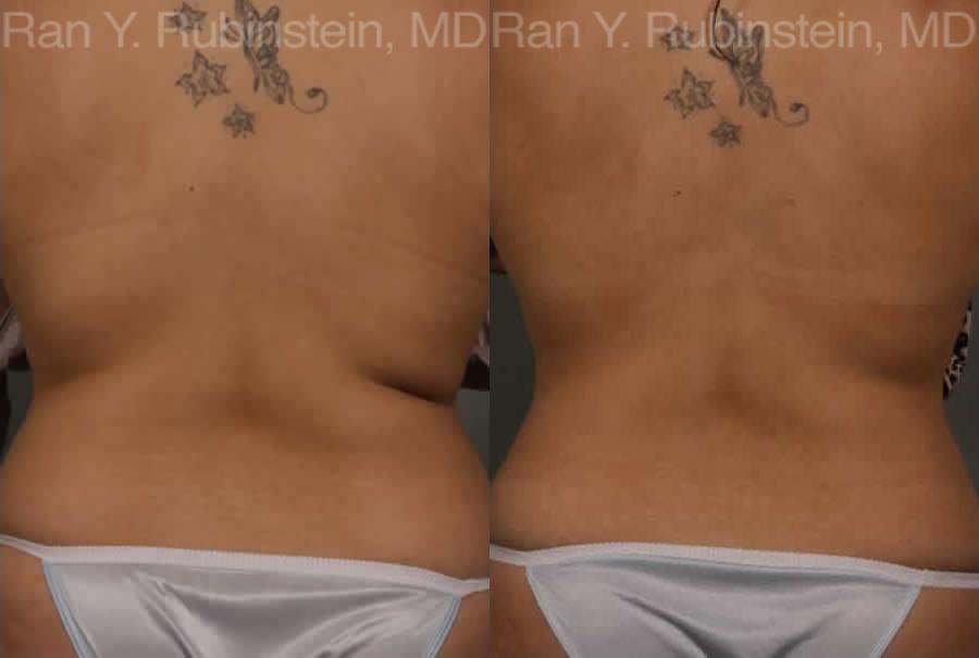 Coolsculpting (Bra Roll and Waistline)
Before: 29 year old before treatment of waist and bra roll
After: 3 months after two CoolSculpting treatments to the bra roll and waistline.
