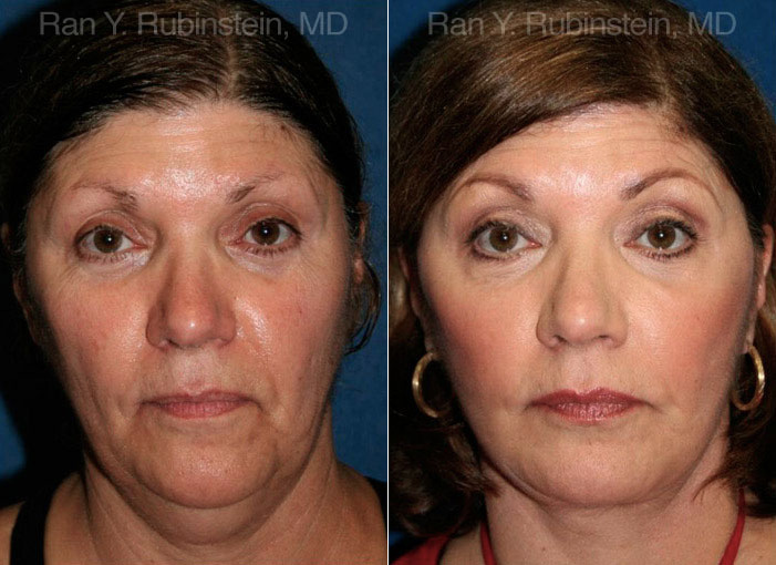 patient-12629-face-lift-neck-lift-before-after-1