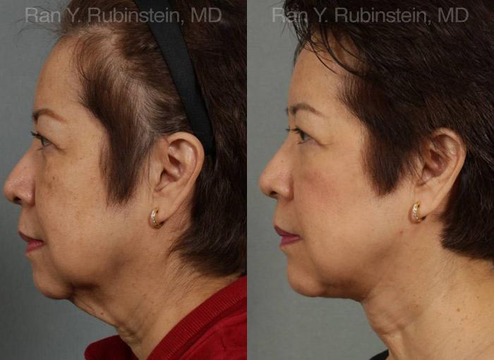 patient-12641-face-lift-amp-neck-lift-before-after-14
