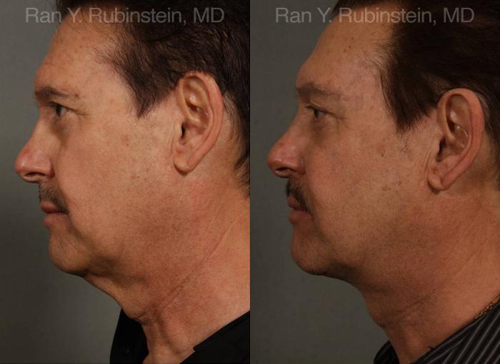 patient-12673-face-lift-amp-neck-lift-before-after-9