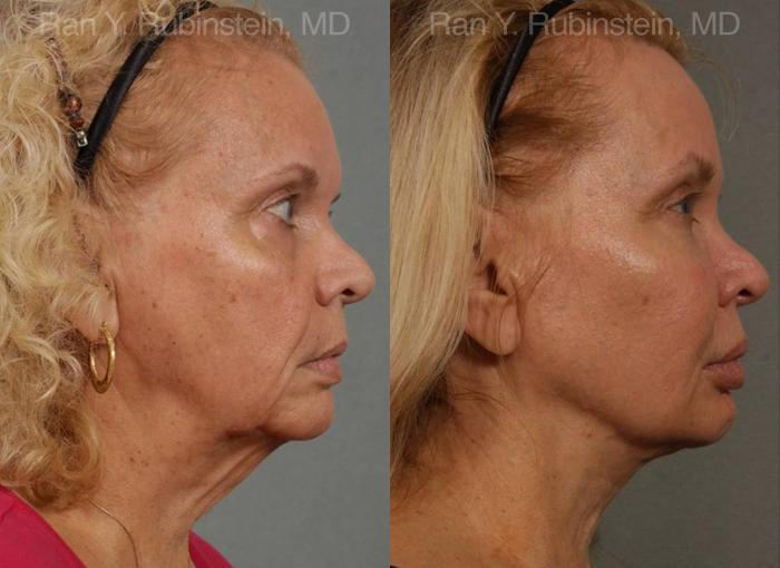 patient-12678-face-lift-amp-neck-lift-before-after-4