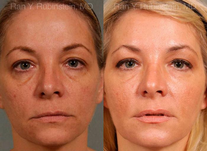 patient-12722-injectable-fillers-before-after-3