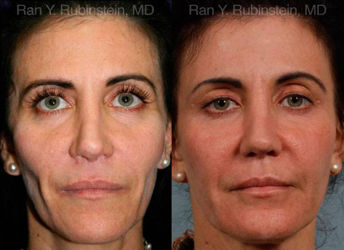 patient-12788-injectable-fillers-before-after-3