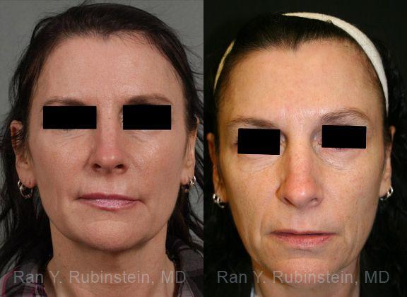 patient-12839-laser-treatment-before-after-3