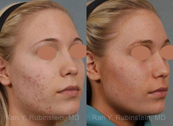 patient-12842-laser-treatment-before-after-8