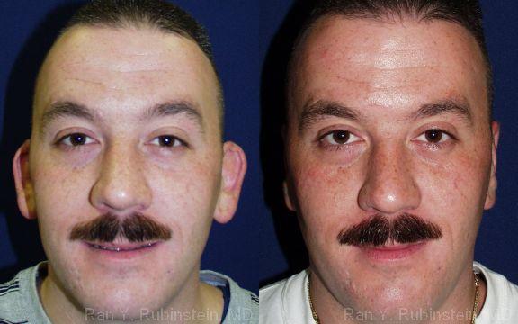 Otoplasty, Ear Reduction.